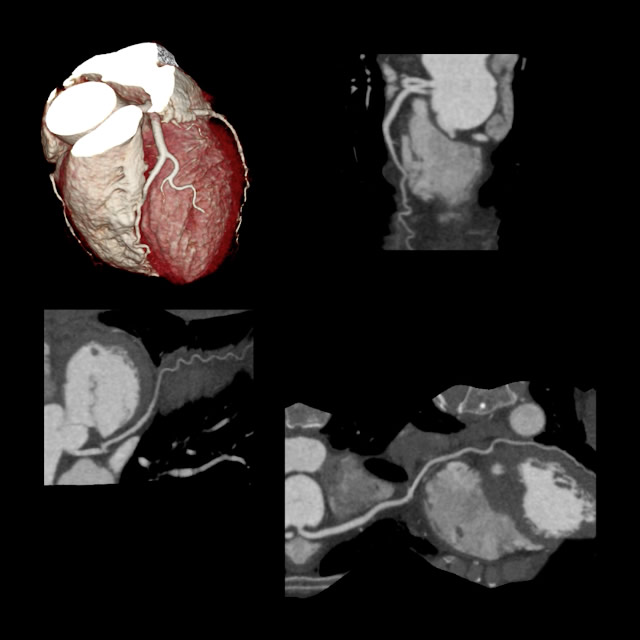 Cardiac CT