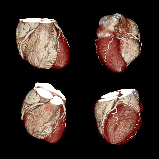 Cardiac CT