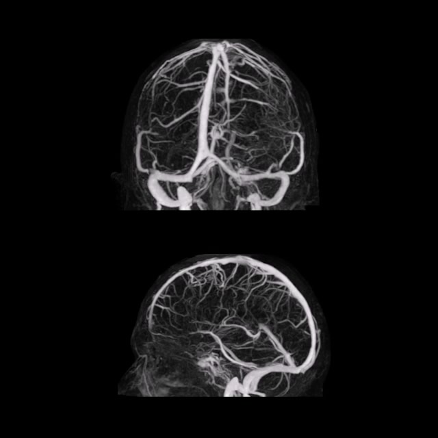 Neuro CT